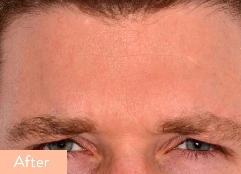 anti-wrinkle treatment results on forehead