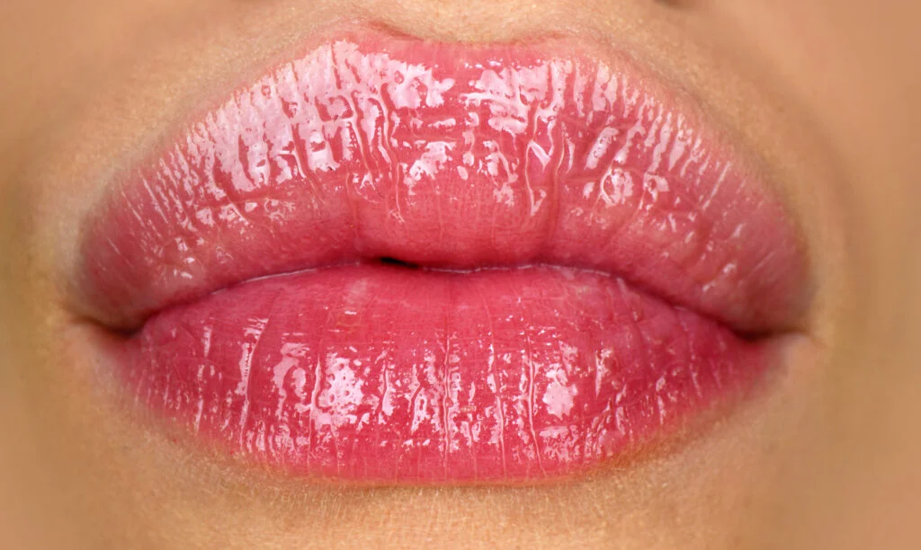 lip fillers Southampton