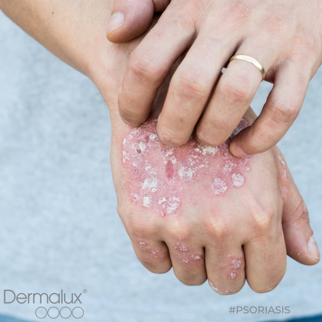 Dermalux Treatment Southampton Beauty Salon Ruma Medispa