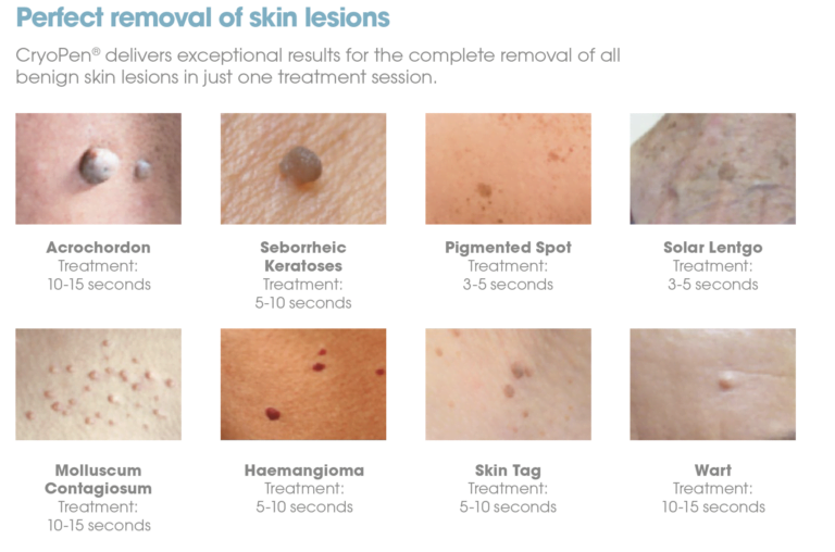 how to remove lesions, moles and skin tags with cryopen treatment