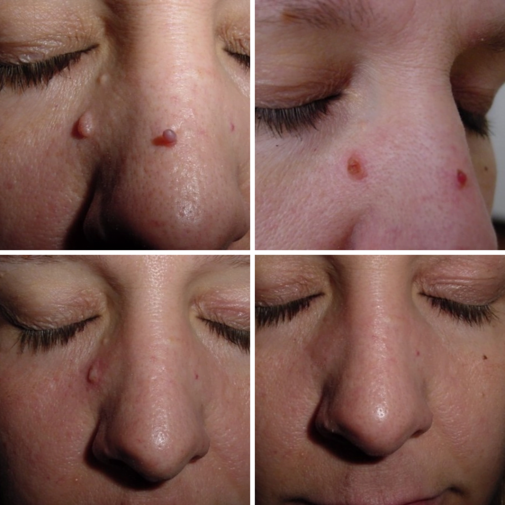 cryopen treatment for lesions and moles in Southampton