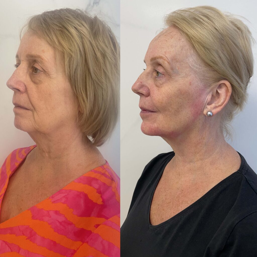 before and after lift treatment side profile
