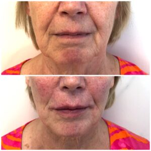 two images above each other of a woman's face from the nose down to the chin, before and after thread lift treatment.