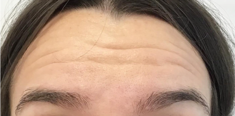 forehead with wrinkles
