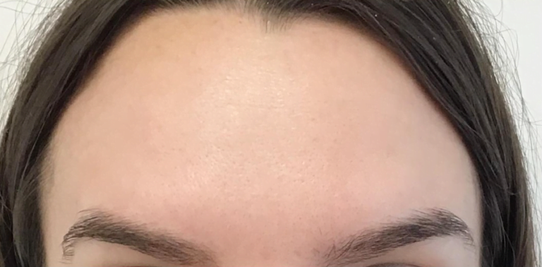 forehead without wrinkles following treatment